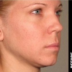 Ultherapy Before & After Patient #1549